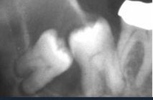 Photo of OMS Center Getting Dental Implants In Lafayette Or Logansport