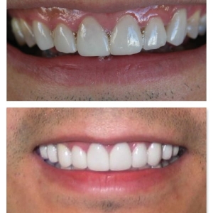 San Francisco Richard A Felton, DDS Cosmetic Dentistry