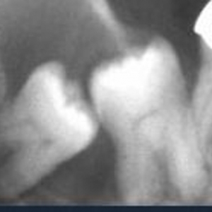 Photo of OMS Center Getting Dental Implants In Lafayette Or Logansport